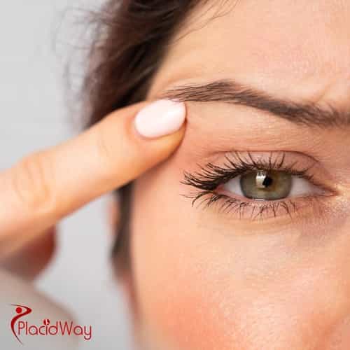 Augenlidoperation in der Türkei: Blepharoplastik für deutsche Patienten zur Augenverschönerung